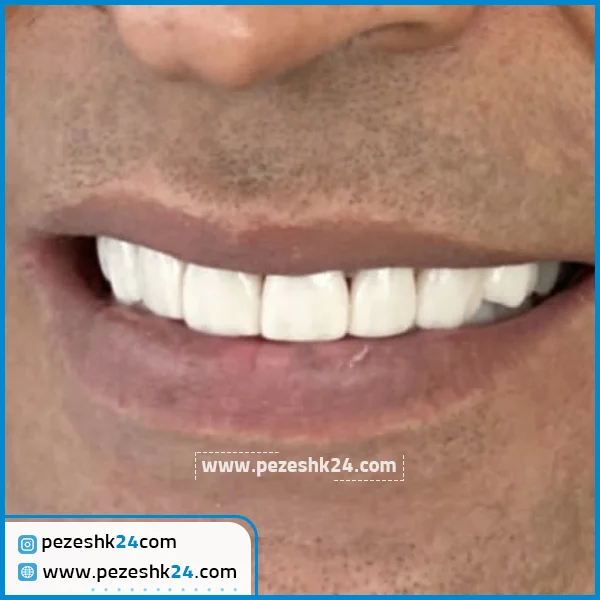 ونیر کامپوزیت دکتر یگانه موسوی زاده