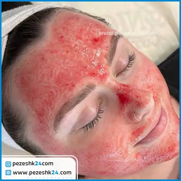 میکرونیدلینگ صورت