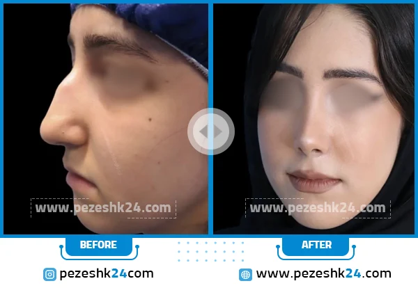 قبل و بعد عمل بینی دکتر ابراهیمی کرج