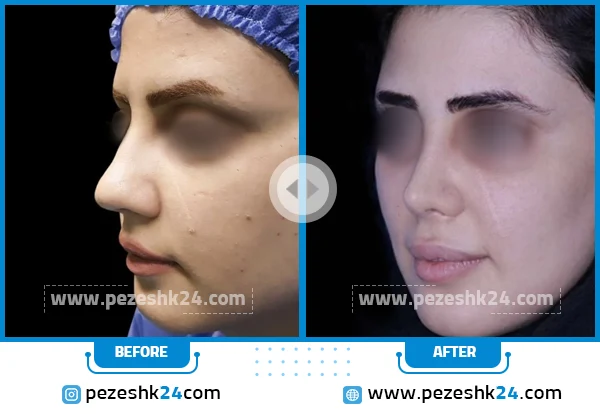 قبل و بعد جراحی بینی دکتر ابراهیمی کرج