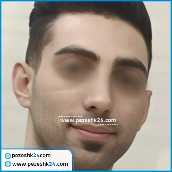 نمونه جراحی بینی دکتر ابراهیمی کرج