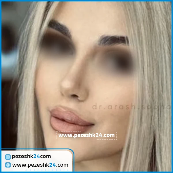 نمونه جراحی بینی دکتر سبحان منش