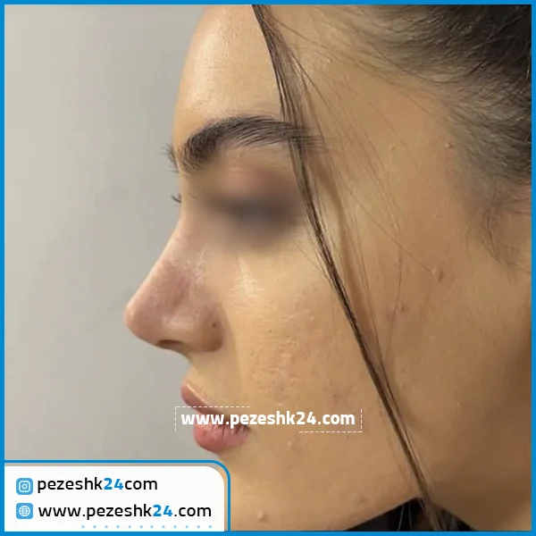 نمونه عمل زیبایی بینی دکتر سبحان منش