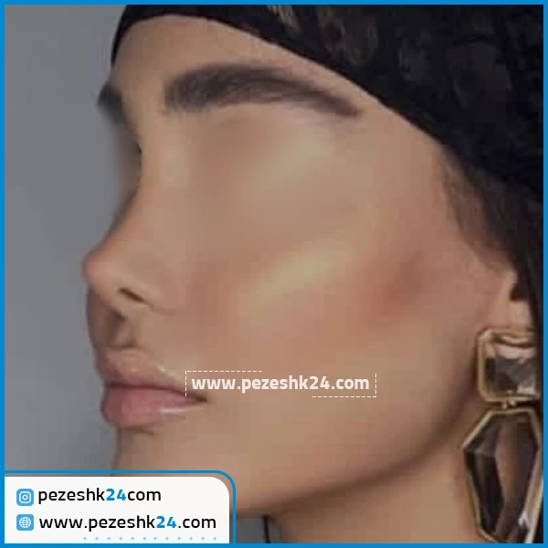 نمونه عمل بینی دکتر ایرج علی اکبری