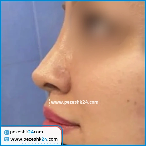 نمونه عمل بینی دکتر علی اکبری