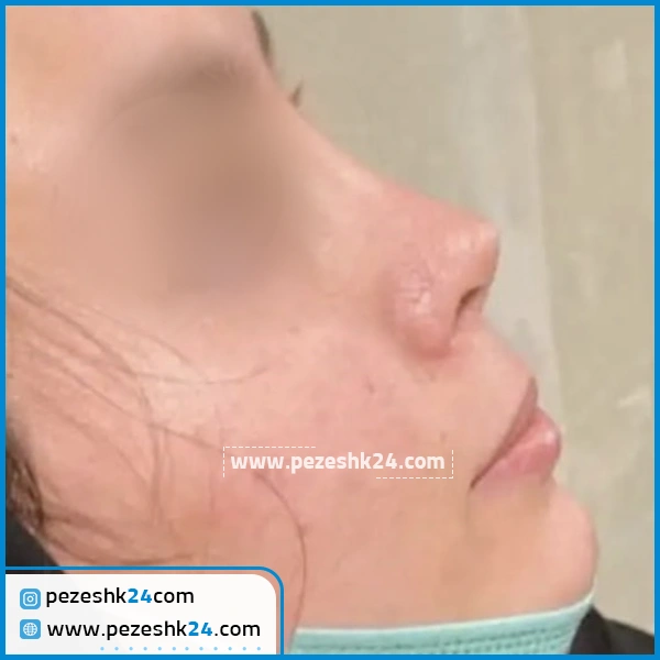 نمونه جراحی بینی دکتر علی اکبری
