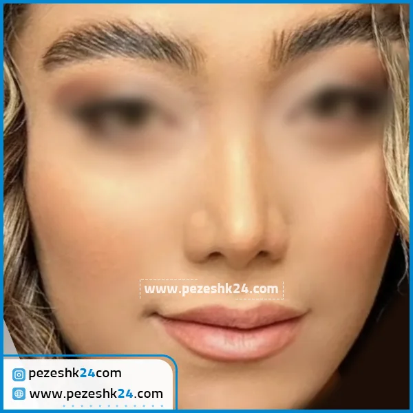 عمل زیبایی بینی دکتر قاسمی