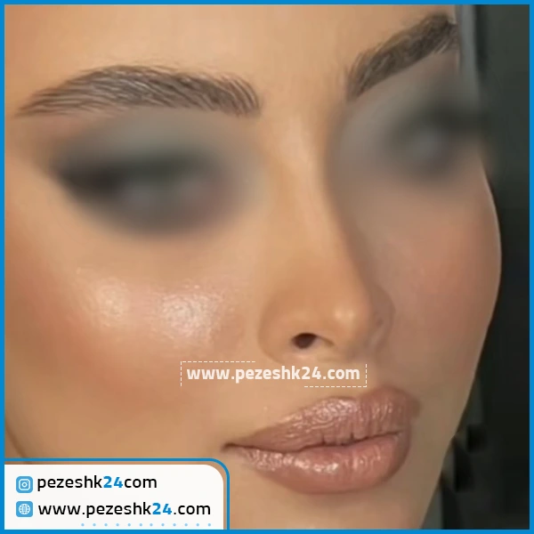 عمل زیبایی بینی دکتر افشین قاسمی کرج