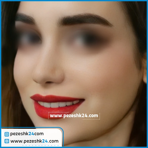 عمل زیبایی بینی دکتر نادر موسوی