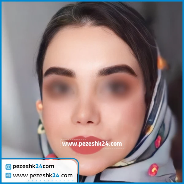 نمونه جراحی زیبایی بینی دکتر موسوی