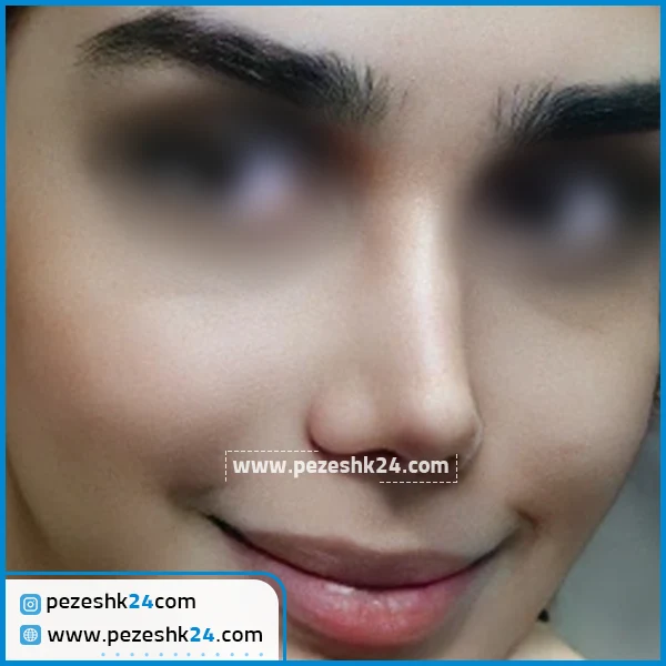 عمل بینی دکتر زرگری