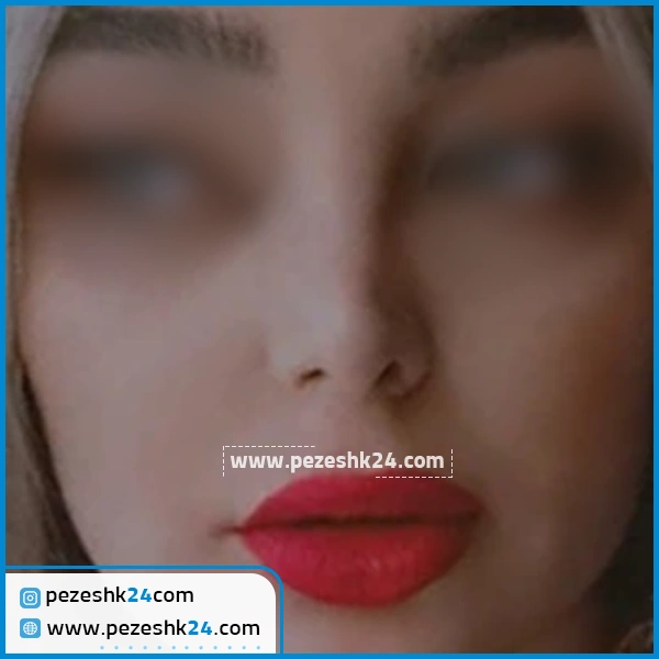 جراحی زیبایی بینی دکتر کاظم زرگری