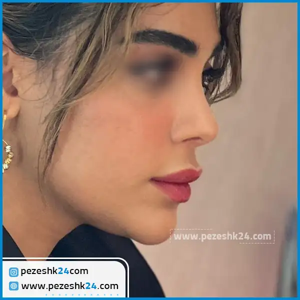 نمونه عمل بینی نیمه فانتزی