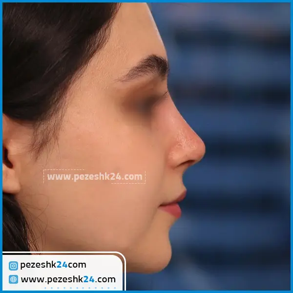 عمل بینی نیمه فانتزی