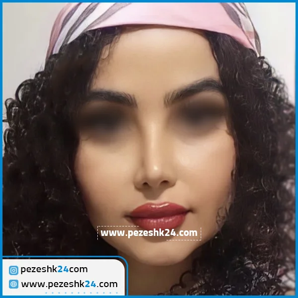 نمونه عمل بینی دکتر ونون آصفی