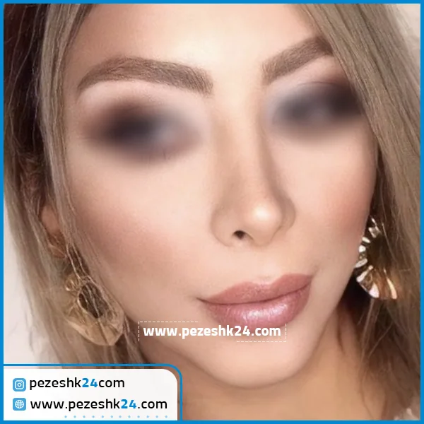نمونه عمل بینی دکتر ونون آصفی شیراز