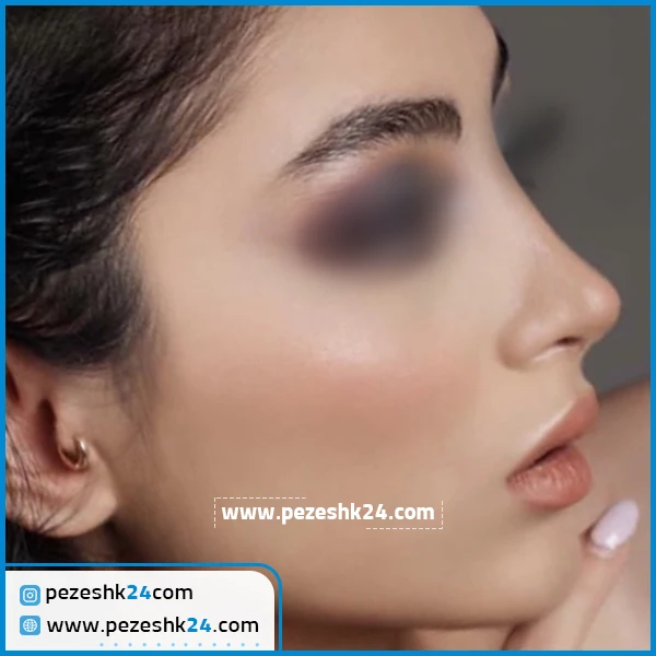 نمونه عمل بینی دکتر آصفی