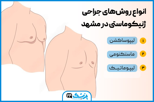 انواع روش های جراحی ژنیکوماستی در مشهد