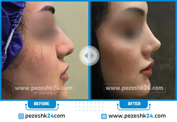 عکس قبل و بعد عمل بینی نیمه فانتزی دکتر وکیلی