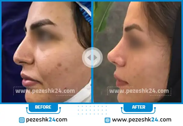 عکس قبل و بعد عمل بینی نیمه فانتزی دکتر وکیلی مشهد