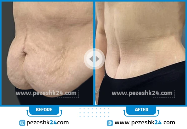 عکس جراحی شکم و پهلو