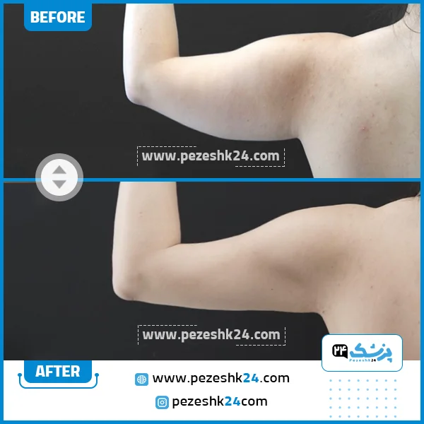 عمل لیپوماتیک بازو