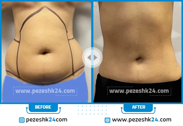 برداشت شکم با لیپوماتیک