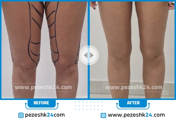 لیپوماتیک ران پا