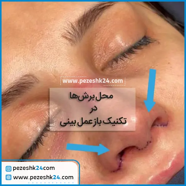 روش عمل بینی باز