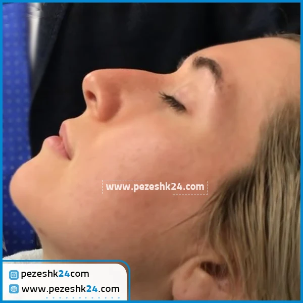 نمونه جراحی بینی گوشتی در تهران