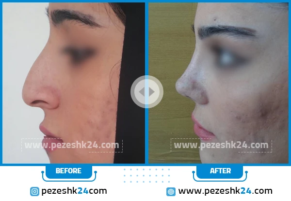 قبل و بعد جراحی زیبایی بینی دکتر شفائی