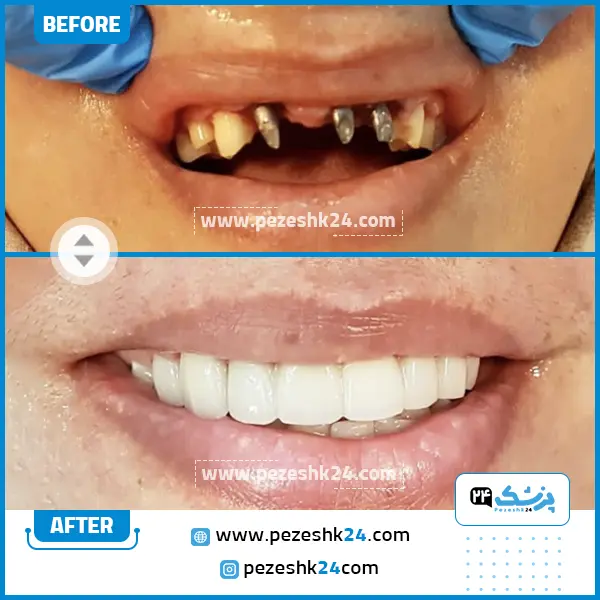 قبل و بعد کامپوزیت دکتر شبستری