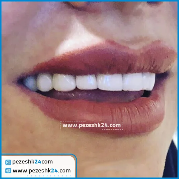 کامپپوزیت دندان دکتر علیرضا شبستری