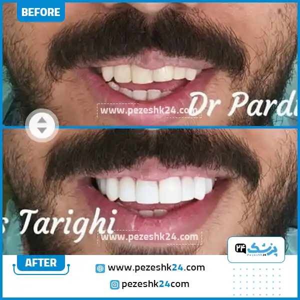 قبل و بعد لمینت دکتر طریقی در اصفهان