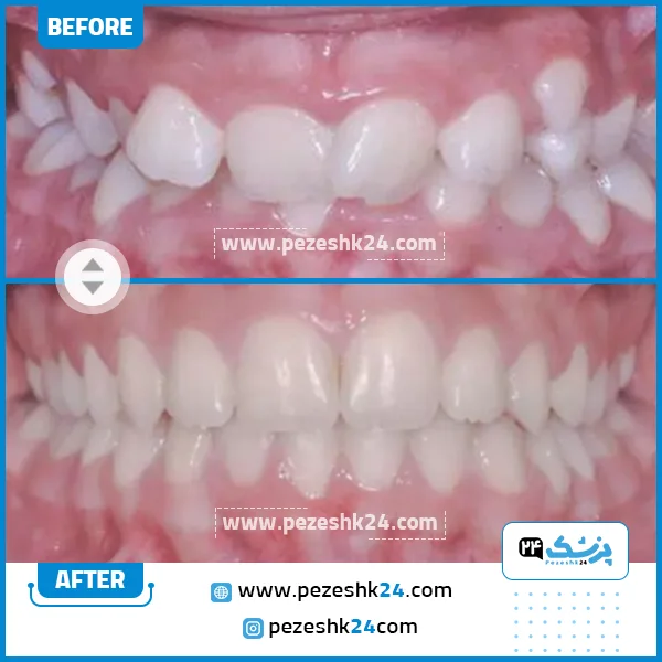 قبل و بعد ارتودنسی دکتر اسلامی مشهد