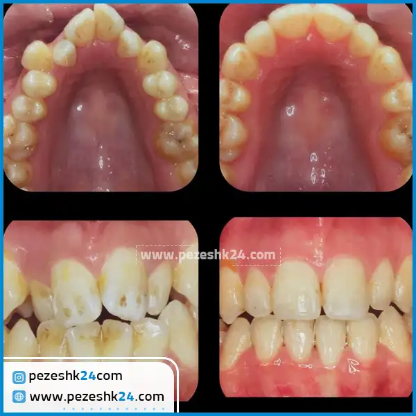 عکس قبل و بعد ارتودنسی دکتر مخبر