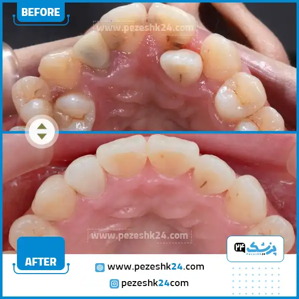 عکس قبل و بعد سیم کشی دندان