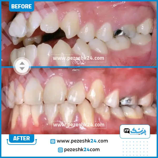 قبل و بعد ارتودنسی دندان دکتر احراری