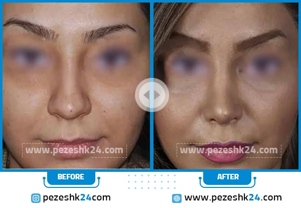 جراحی بینی گوشتی تهران