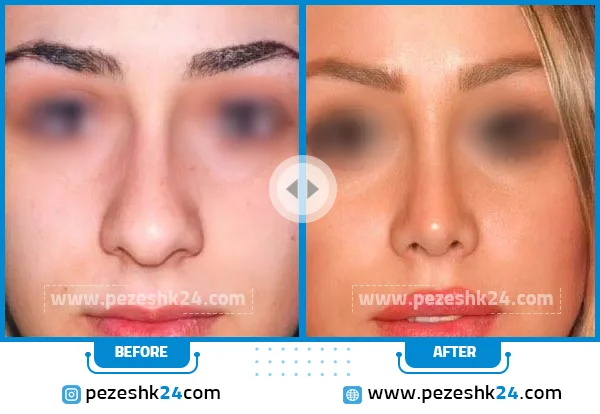 قبل و بعد جراحی بینی گوشتی تهران