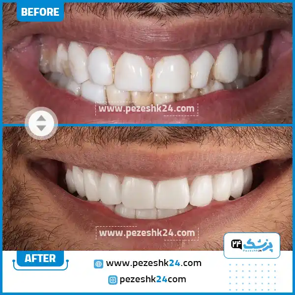 قبل و بعد لمینت دندان دکتر فرهاد اسماعیلی