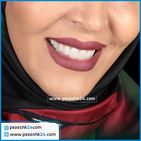 قبل و بعد لمینت دندان دکتر اسماعیلی