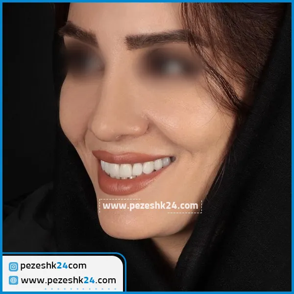 لمینت دندان دکتر اسماعیلی