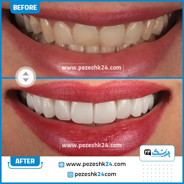 قبل و بعد لمینت دکتر اسماعیلی