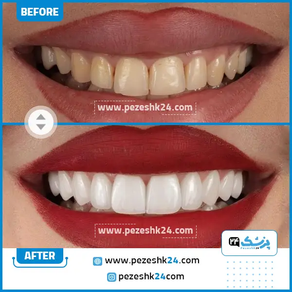 قبل و بعد از لمینت دندان دکتر اسماعیلی