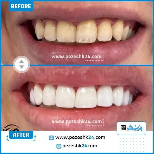 قبل و بعد لمینت دندان دکرت زهره سامع