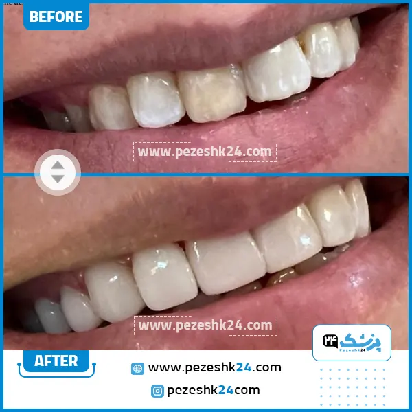 قبل و بعد از لمینت دندان دکتر سامع