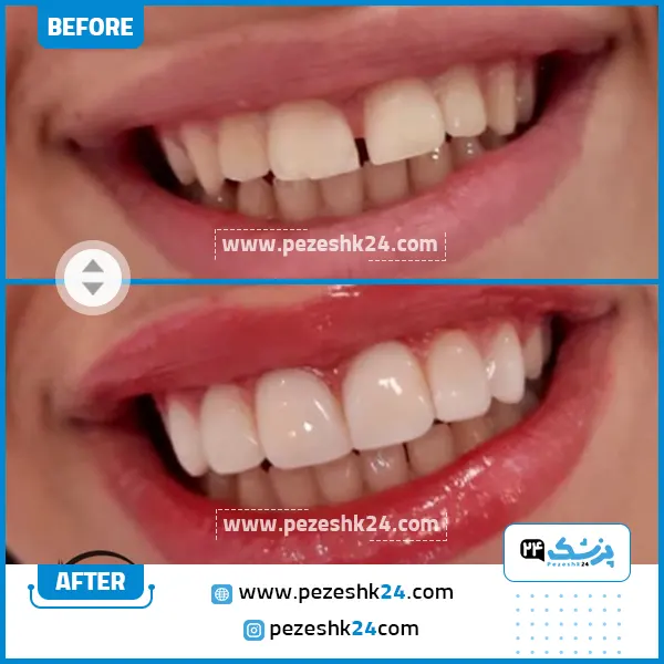 قبل و بعد لمینت سرامیکی دکتر سامع