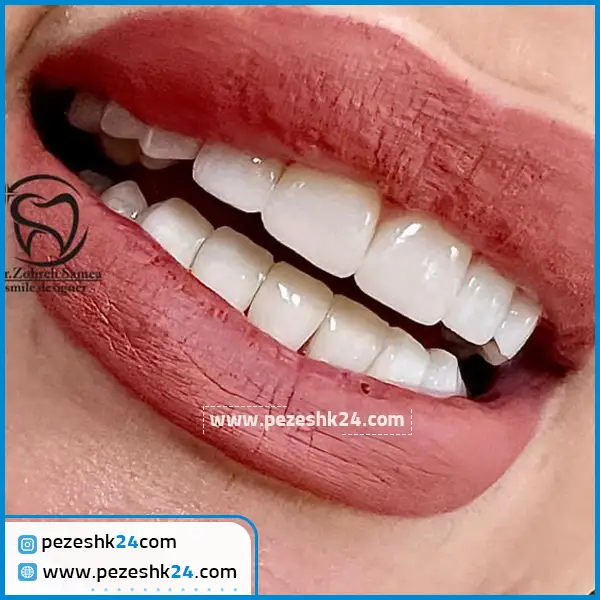 نمونه لمینت دندان دکتر زهره سامع