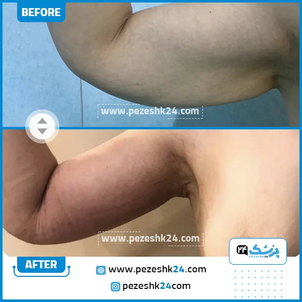 قبل و بعد از لیپوماتیک دکتر رضایی مشهد
